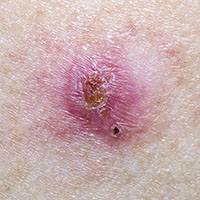 Basal Cell Carcinoma