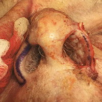 Folded paramedian forehead flap (second stage) 2