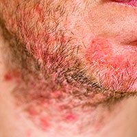 Seborrheic Dermatitis